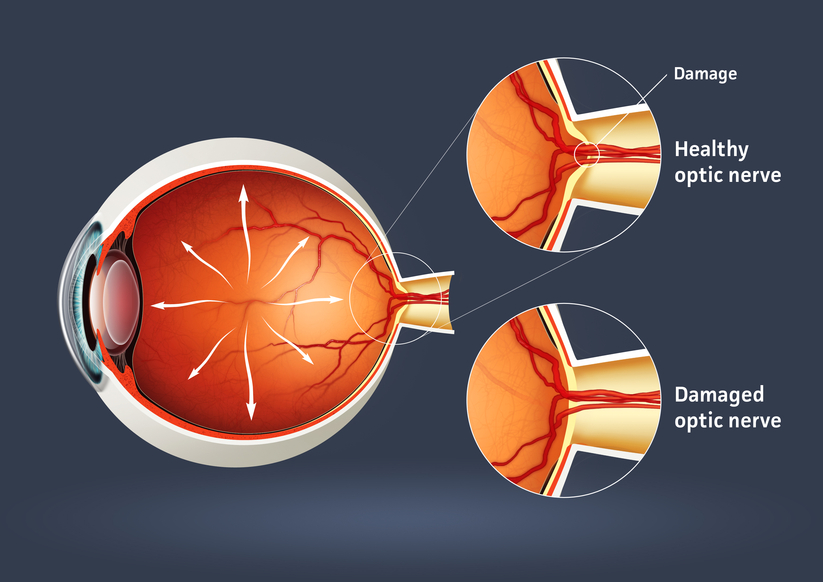 Glaucoma Illustration